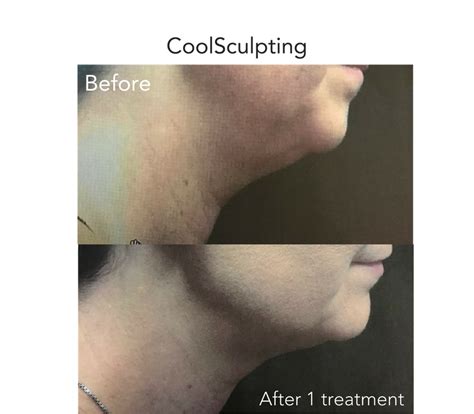 Why We Decided Not To Offer CoolSculpting at Derma Health | Derma ...