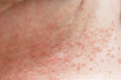 How to Get Rid of Heat Rash (Prickly Heat) - Riverchase Dermatology