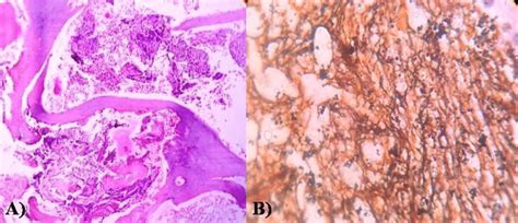 Myelofibrosis; A): Trephine biopsy showing evidence of marrow fibrosis... | Download Scientific ...