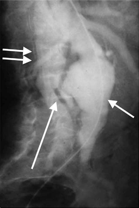 Conventional catheter aortogram demonstrating a spontaneous aortocaval... | Download Scientific ...