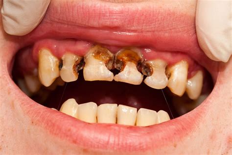 Rotten Teeth: Causes, Symptoms, Treatment, and Prevention