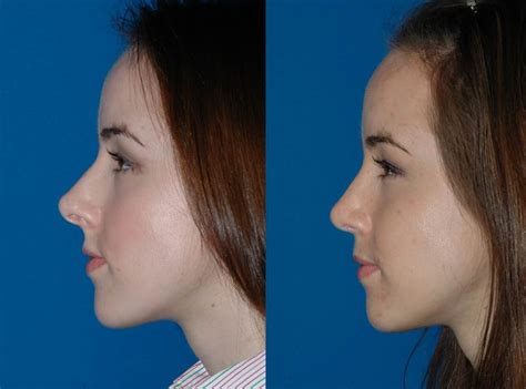 Rhinoplasty Seattle | Rhinoplasty Specialist | Bellevue Rhinoplasty