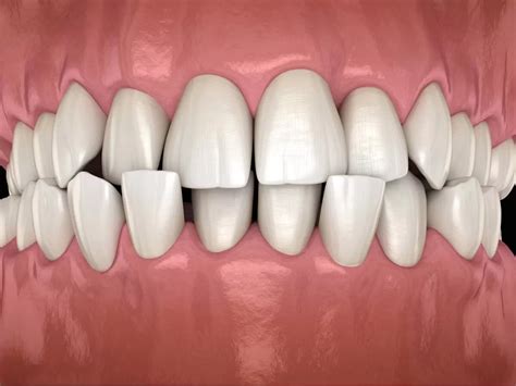 Understanding Crossbite: Causes, Effects, and Correction Methods