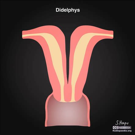 Didelphys Uterus Ultrasound