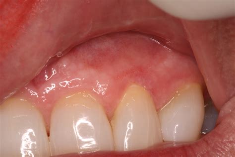 Gum Infection - Oklahoma City Periodontist- Ryan Lanman DDS MSD
