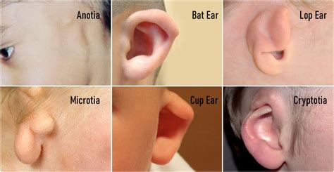 Types of Ear Deformities and Treatments