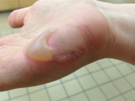 burn blister | 2nd degree burns, Degree burns, Burns