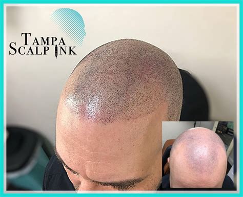 Before and after pictures of scalp micropigmentation ⋆ Tampa Scalp Ink