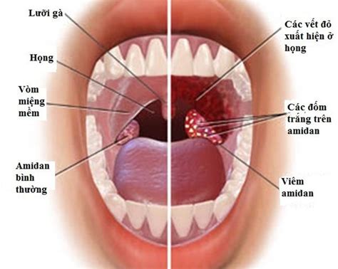 Swollen Lymph Nodes Neck Strep Throat