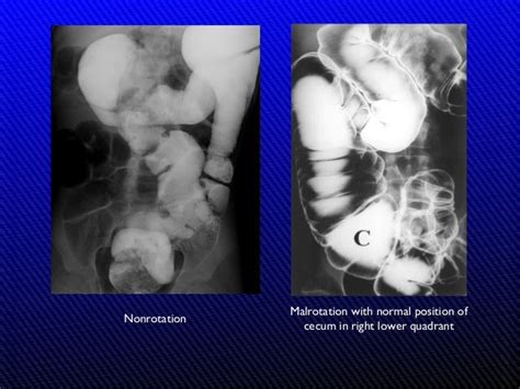 The Radiology of Malrotation