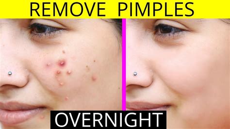 Pimples On Face Removal Tips