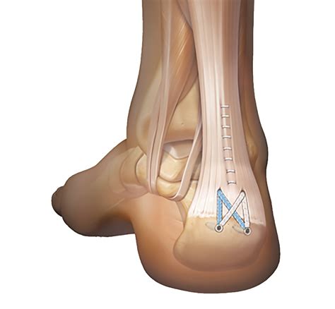 Treatment options for chronic Achilles tendon disorders