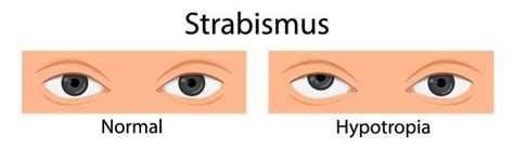 Strabismus Treatment Illustrations, Royalty-Free Vector Graphics & Clip Art - iStock