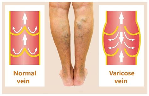 Chronic Venous Insufficiency: Signs, Symptoms, Prevention and Treatment