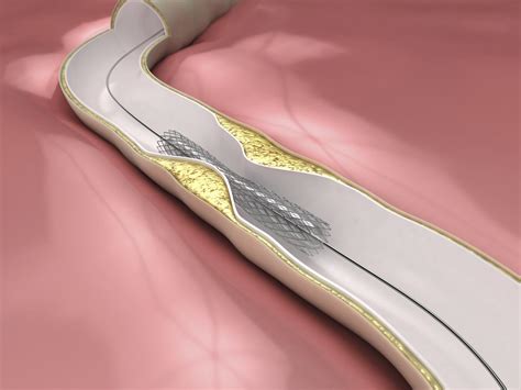 A Treatment To Dissolve Blood Clots In A Blocked Coronary Vessel at ...