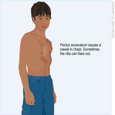 Born with a Hole in your Chest? [What is Pectus Excavatum?] – The J Word