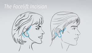 An Overview of Facelift Incision Lines and Scars - Jason Cooper MD