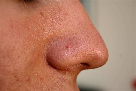 How to get rid of blackheads on nose in 10 minutes