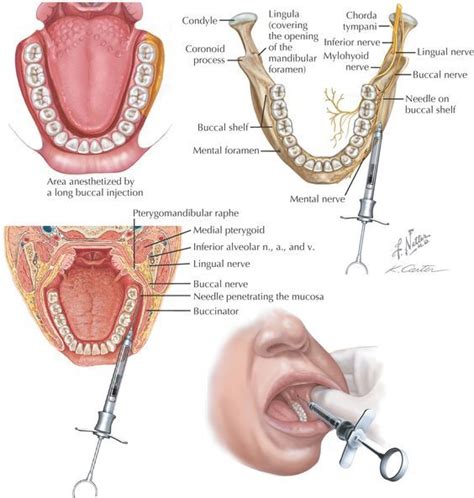 Long Buccal Nerve Block - ColtzebPotter