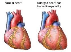 Alcoholic Cardiomyopathy | Causes, Symptoms & Treatment