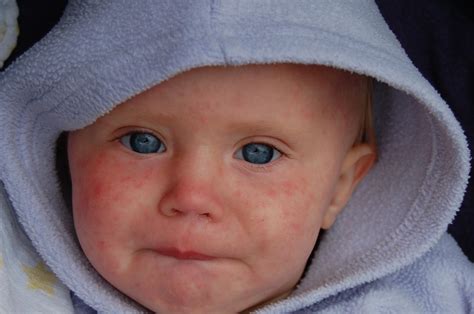 Measles Treatment: eight Home Remedies To Help You Recover - Well Zapness