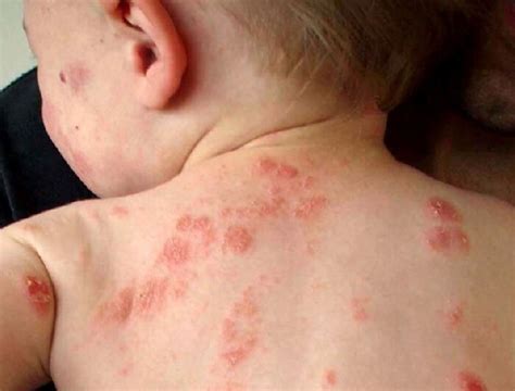 Stress-Induced Eczema: How Parental Stress is Hurting Your Kids - Dr ...