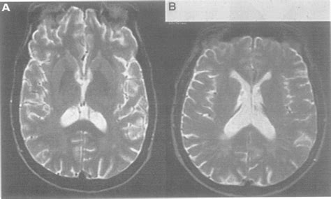 T2 weighted MRI showing patchy diffuse white matter hyperintensity in a ...