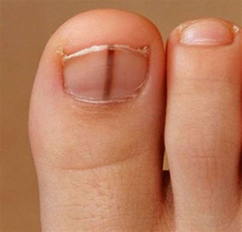 All 95+ Images What Does A Dying Fingernail Look Like Superb 10/2023