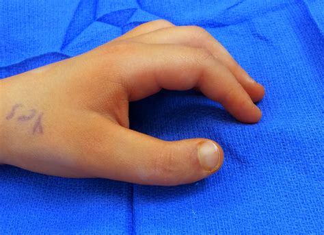 Triphalangeal Thumb | Congenital Hand and Arm Differences