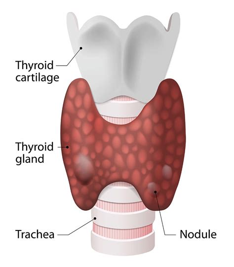 Thyroid Nodules and Thyroid Surgery Brisbane — Sunnybank Surgical Group | Brisbane General ...