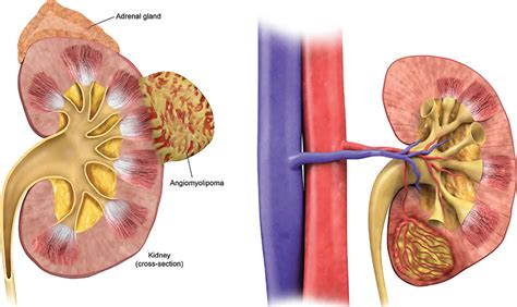 Angiomyolipoma or renal angiomyolipoma, causes, symptoms & treatment