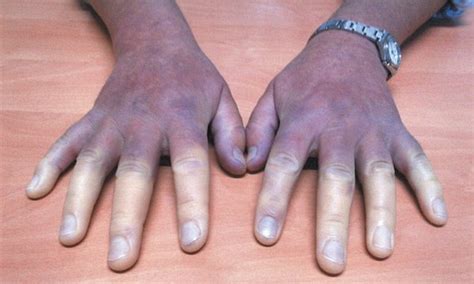 Think you get cold fingers in the winter? Spare a thought for this woman: Spanish patient's ...