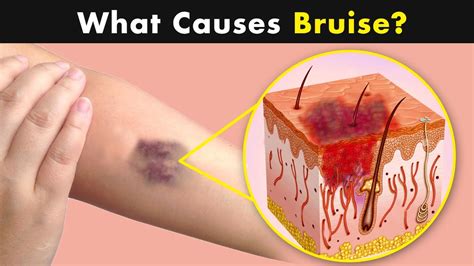 Bruises - Why does it happens? | Symptoms, Causes and treatment (Urdu/Hindi) - YouTube