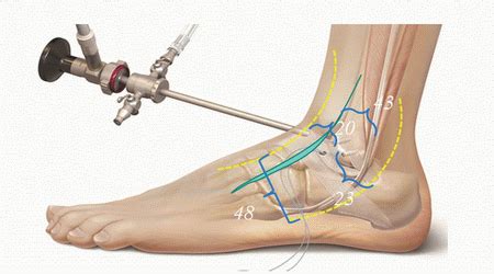 Arthroscopy of the Ankle | Musculoskeletal Key