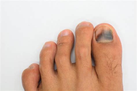 Bruise underneath the toenail (subungual hematoma) - OC Foot and Ankle ...