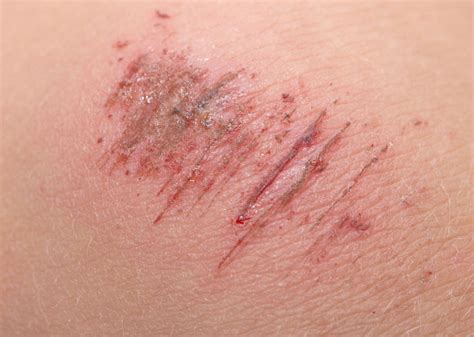 ABRASIONS AND ITS TYPES | Galnet Wiki | Fandom