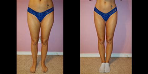 Before & After Cellulite Reduction by Dr. Nwizu