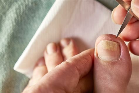 White Toenails & White Spots on Toenails, Explained | Rocky Mountain Foot & Ankle