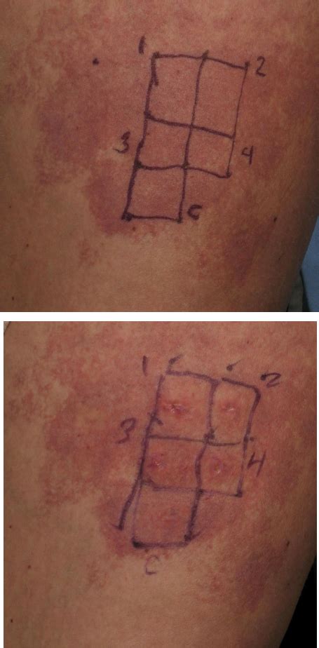 An adult woman with a previously untreated capillary malformation at... | Download Scientific ...