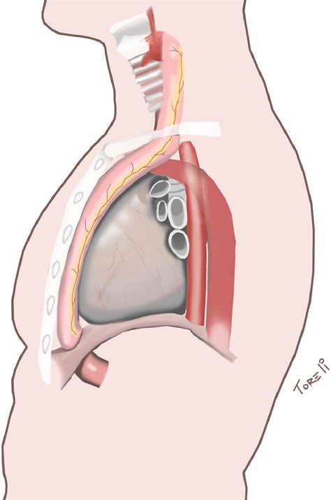 Surgical management of esophageal stenosis due to ingestion of corrosive substances - Journal of ...