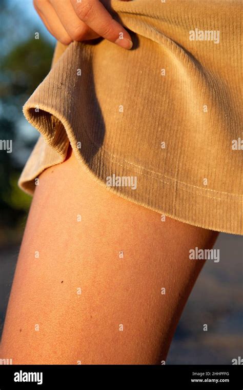Young white woman leg with moles in golden skirt Stock Photo - Alamy