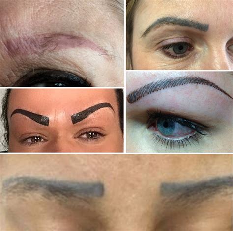 Eyebrow Tattoo Removal Before And After - Best Tattoo Ideas For Men & Women