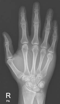 Persistent ulnar styloid ossicle | Radiology Reference Article | Radiopaedia.org