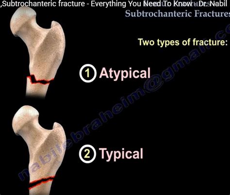 Subtrochanteric fractures — OrthopaedicPrinciples.com