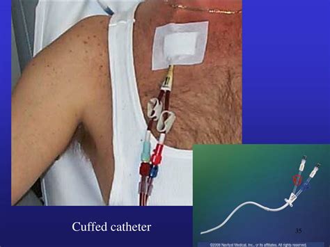 3 Types Of Vascular Access Ports Used In Hemodialysis