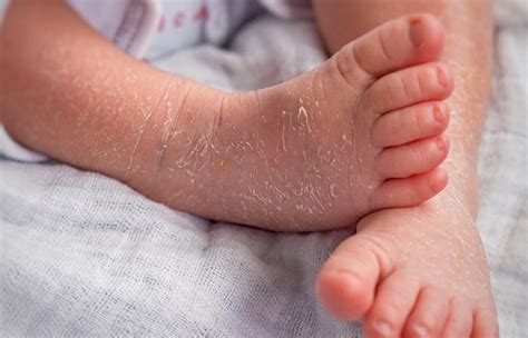 Ichthyosis Vulgaris Causes Symptoms And Treatment - Live Heathly Life