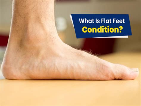 Flat Feet: Symptoms, Causes And Risks | OnlyMyHealth