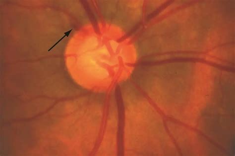 Flame-shaped disc hemorhage - American Academy of Ophthalmology