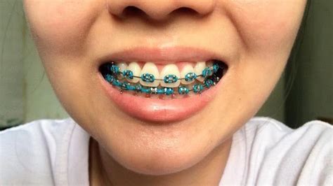 Pin by Karen Josefina on brackets | Braces colors, Orthodontics braces ...