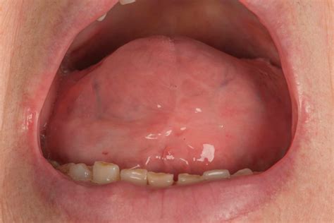 Surgical management of macroglossia secondary to amyloidosis | BMJ Case ...